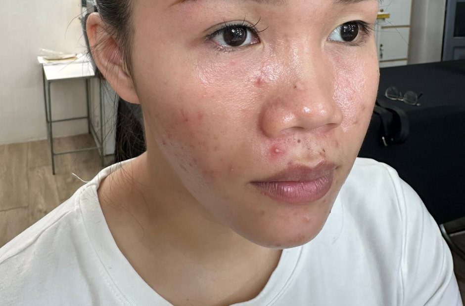 Da mặt mộc trước khi đánh nền, có vài nốt mụn và vùng không đều màu