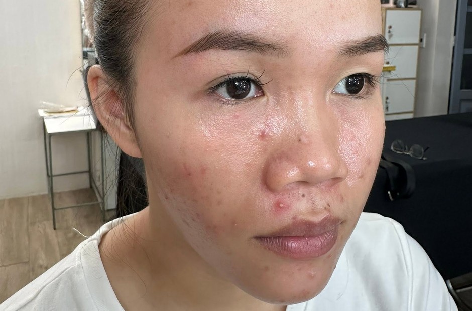 Cận cảnh nửa mặt, vùng má và quanh miệng ửng đỏ, có vài nốt mụn